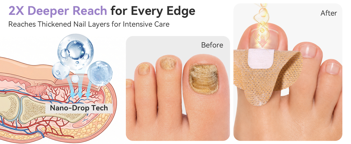 fungal nail patches