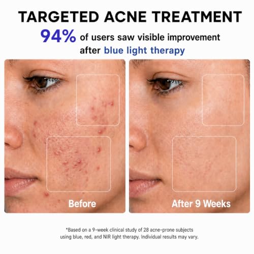 FDA-Cleared Blue Light Mask for Acne NIR + Red LED Light Face Mask for Anti Fine Lines