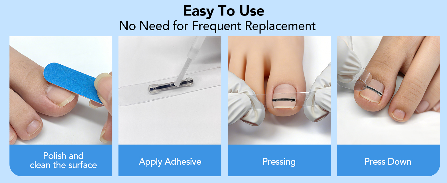 Titanium Alloy Ingrown Toenail Treatment