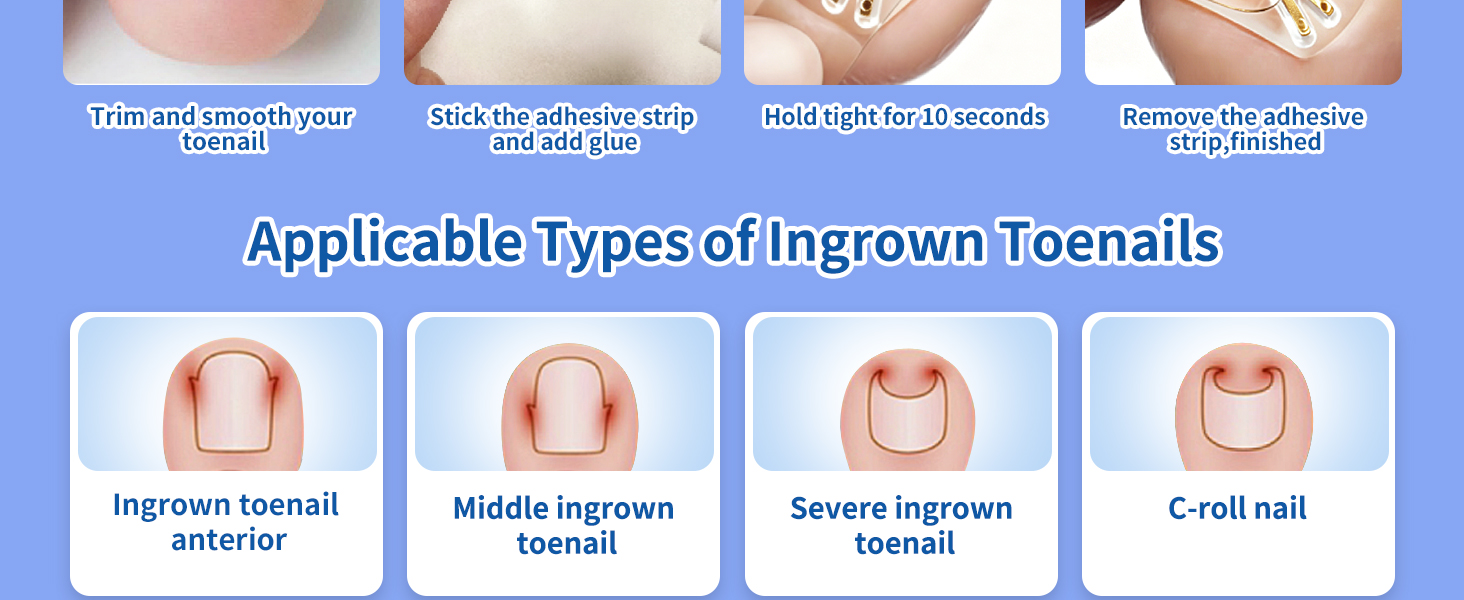 Golden Titanium Ingrown Toenail Corrector