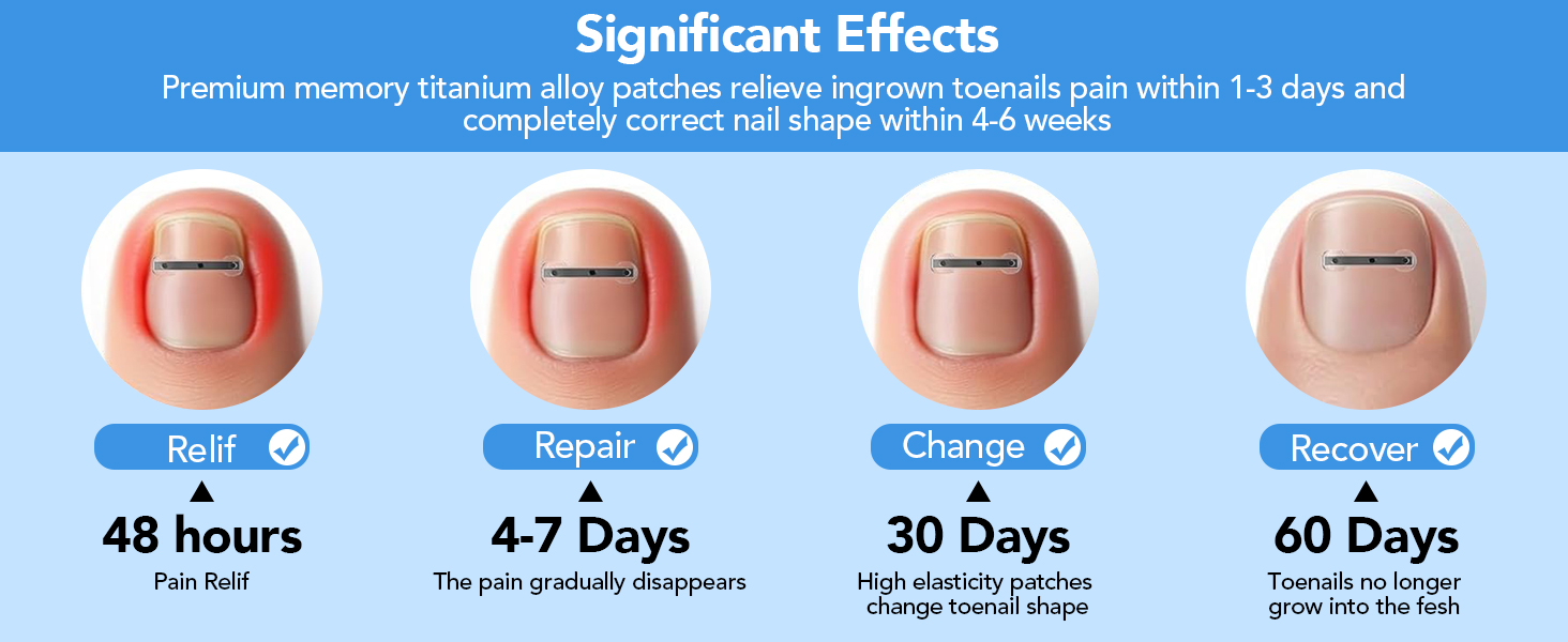 Titanium Alloy Ingrown Toenail Treatment